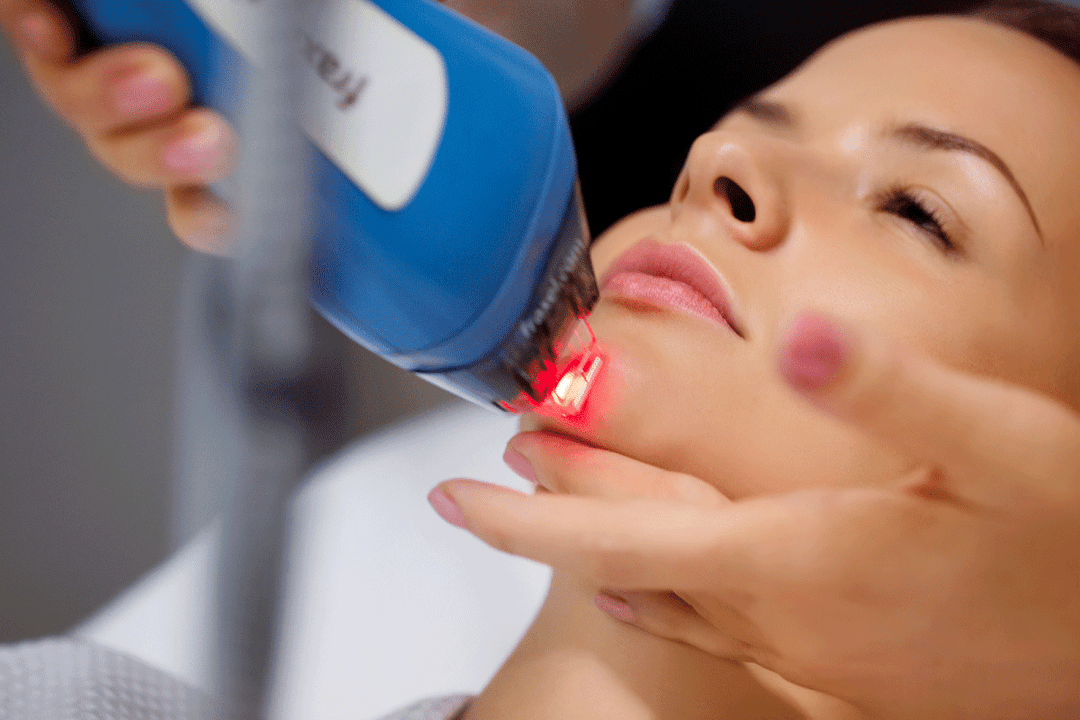 лазерное омоложение кожи лица