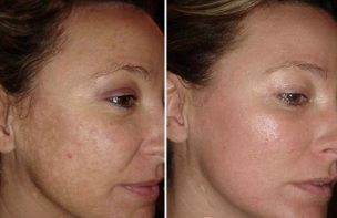 лазерное омоложение кожи лица фото до и после